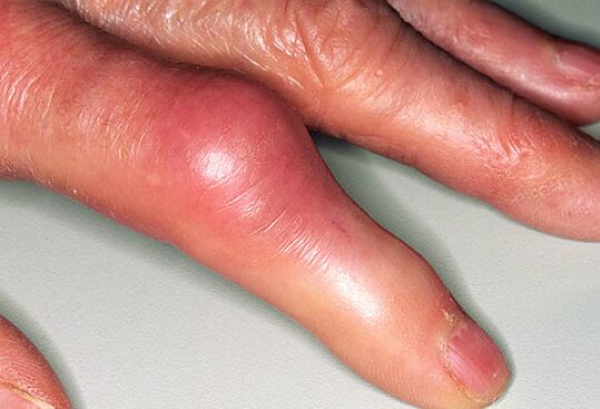 Podagraga kaasneb terav valu sõrmedes ja liigeste turse. 