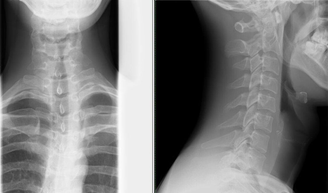 Lülisamba röntgenuuring on lihtne ja tõhus meetod osteokondroosi diagnoosimiseks